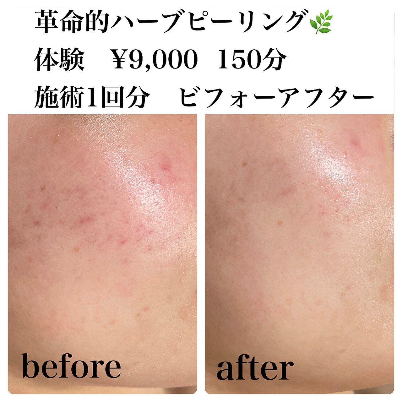 ララピールとお顔脱毛のセット
